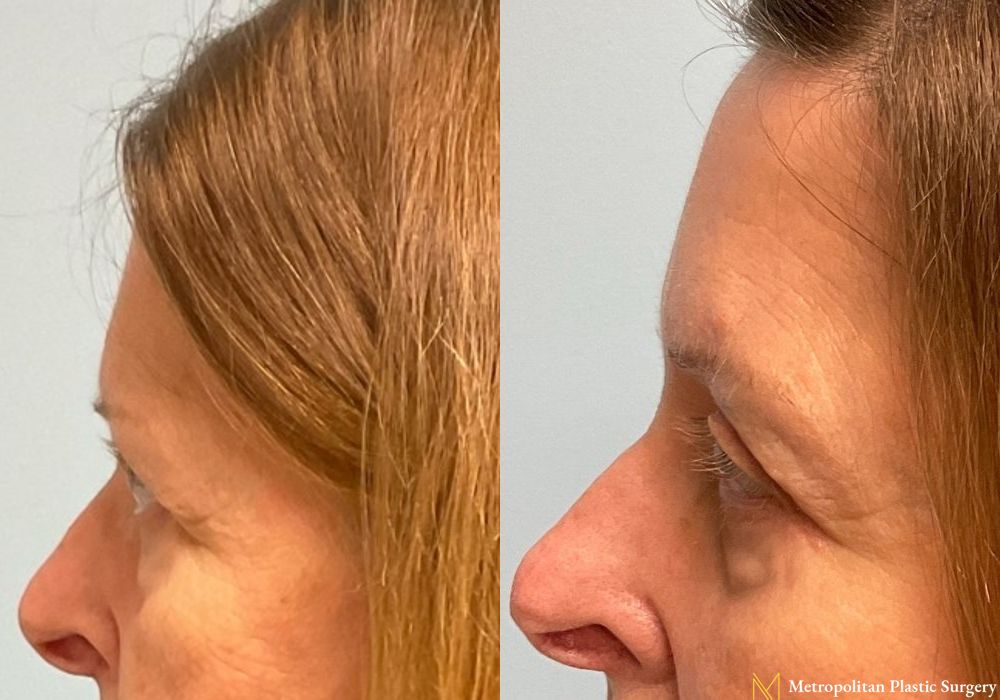 Blepharoplasty - Thumbnail 4