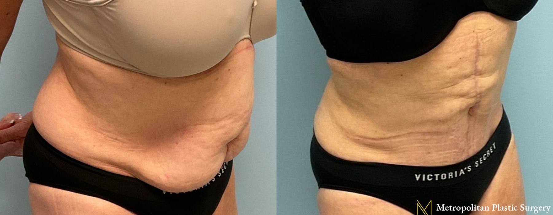 Abdominoplasty - Thumbnail 3