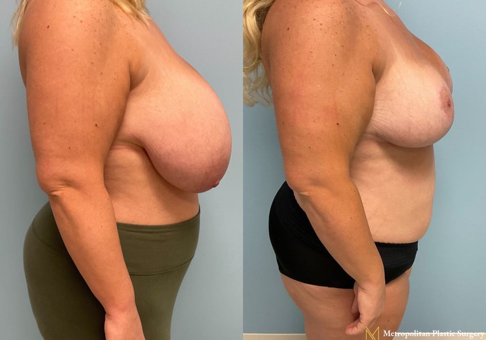 Breast Reduction - Case 107