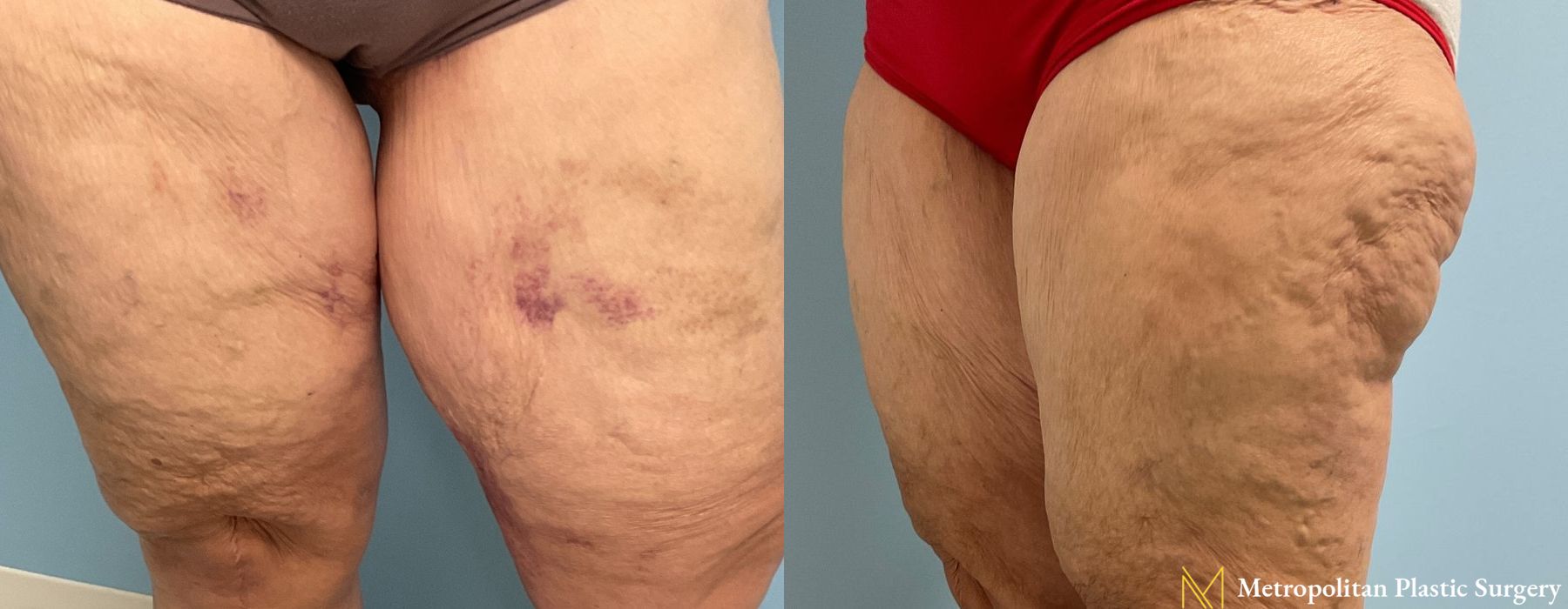 Liposuction - Thumbnail 3