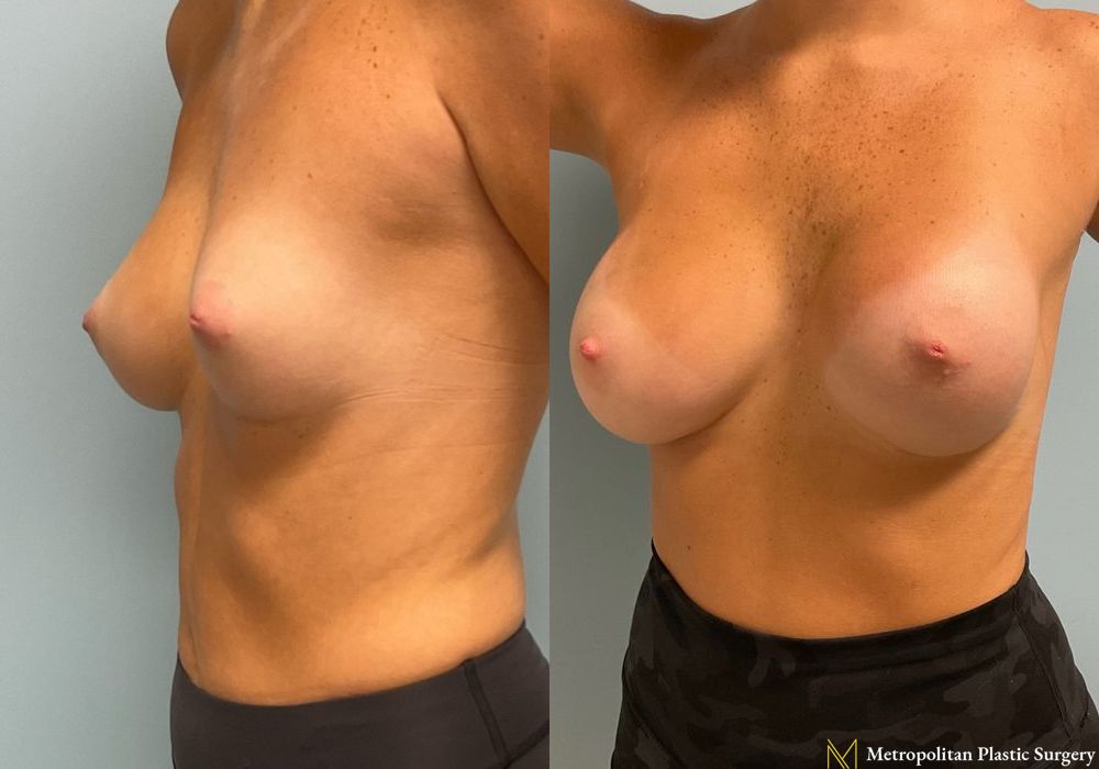 Breast Augmentation - Thumbnail 3