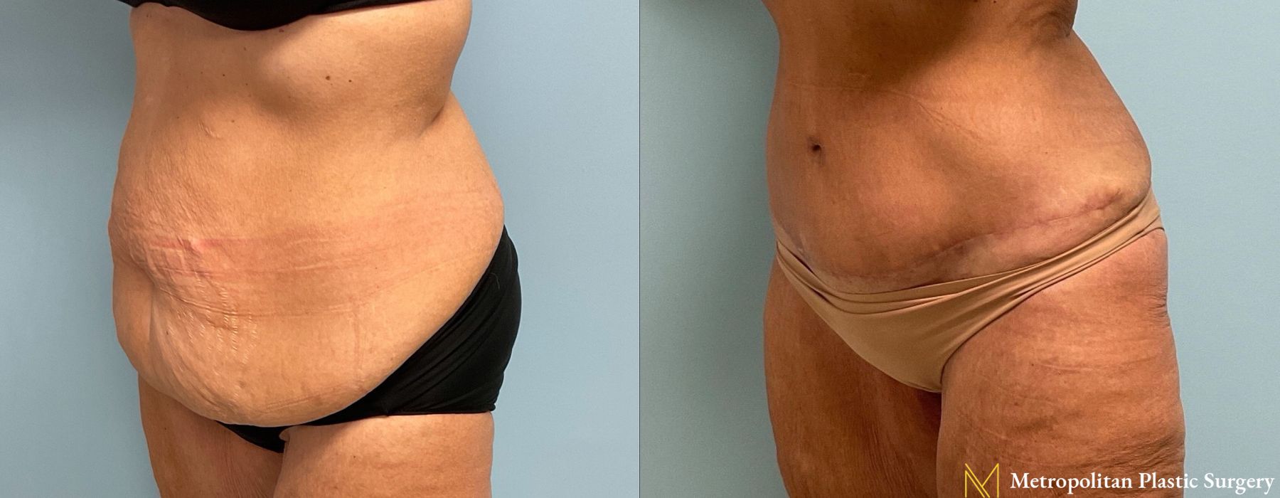 Liposuction - Thumbnail 2