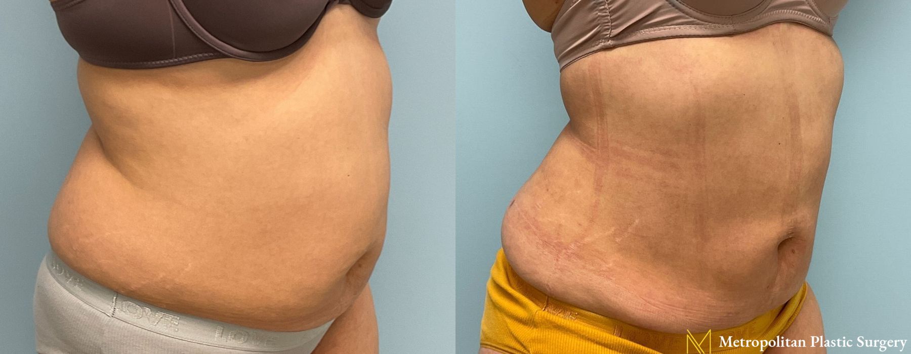 Abdominoplasty - Thumbnail 3