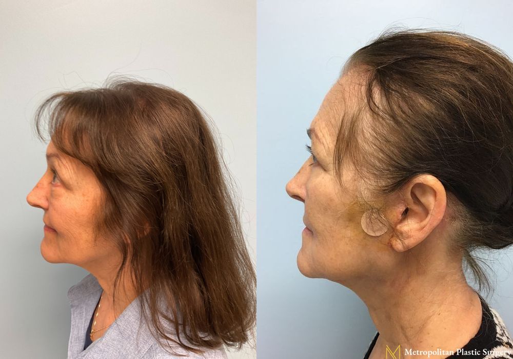 Facelift & Neck Lift - Thumbnail 4
