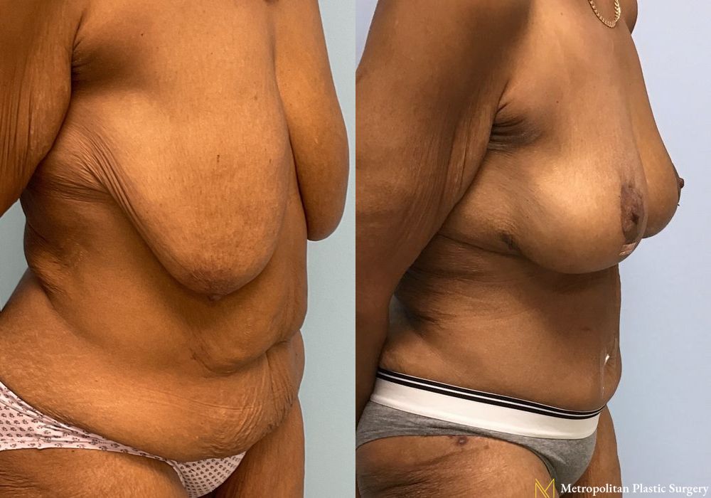 Abdominoplasty - Thumbnail 4