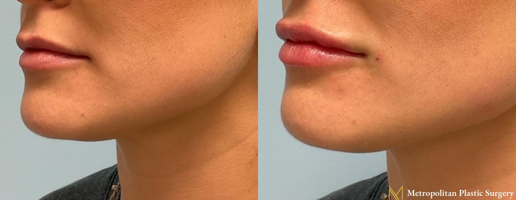 Fillers - Thumbnail 2