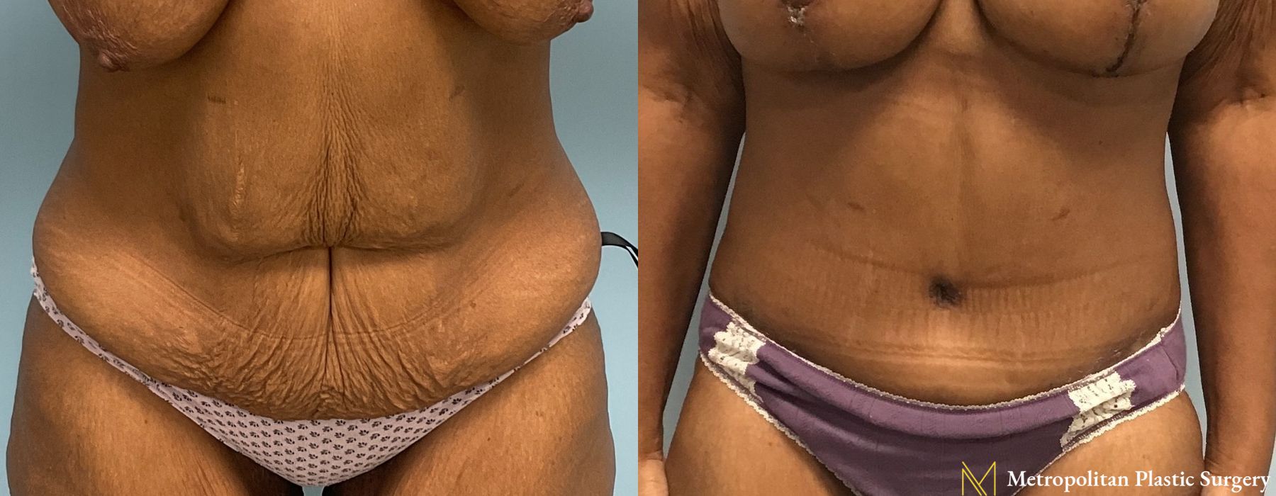 Liposuction - Case 210