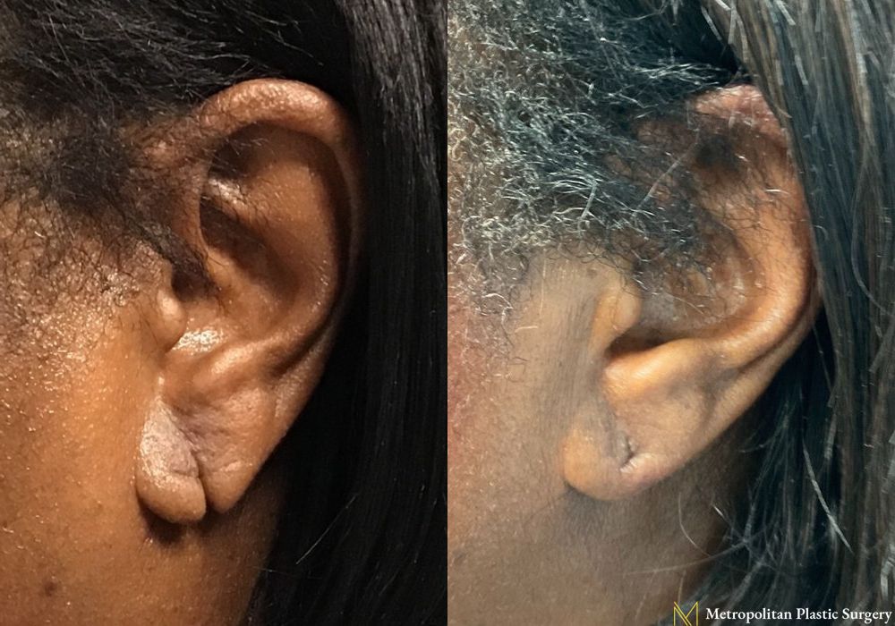 Earlobe Surgery - Case 125