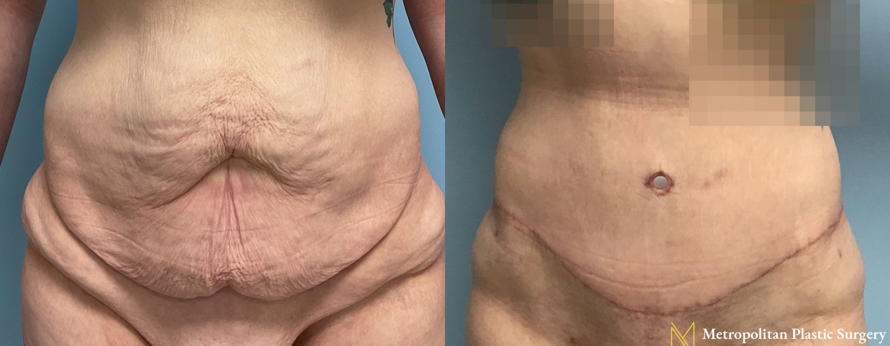 Abdominoplasty - Case 70