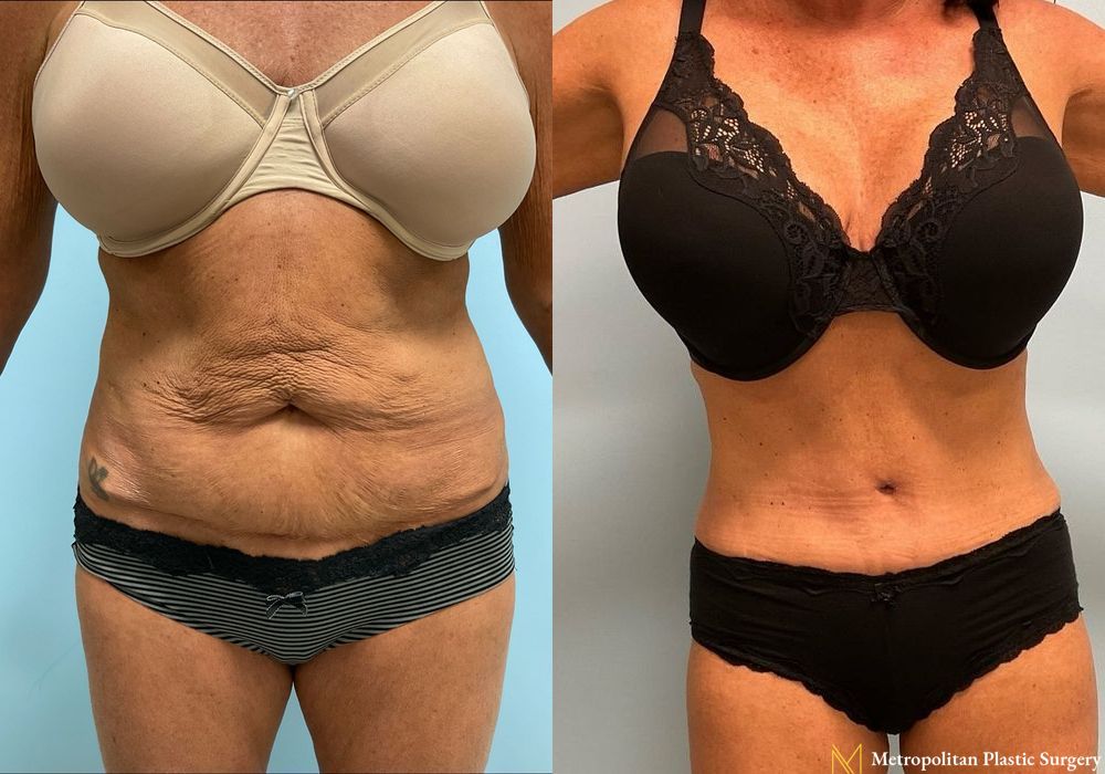 Abdominoplasty - Case 159