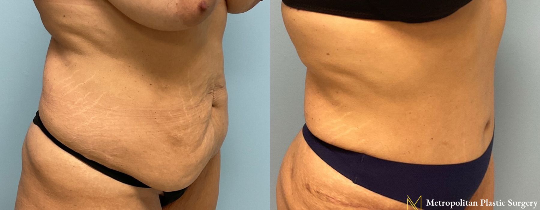 Liposuction - Case 91