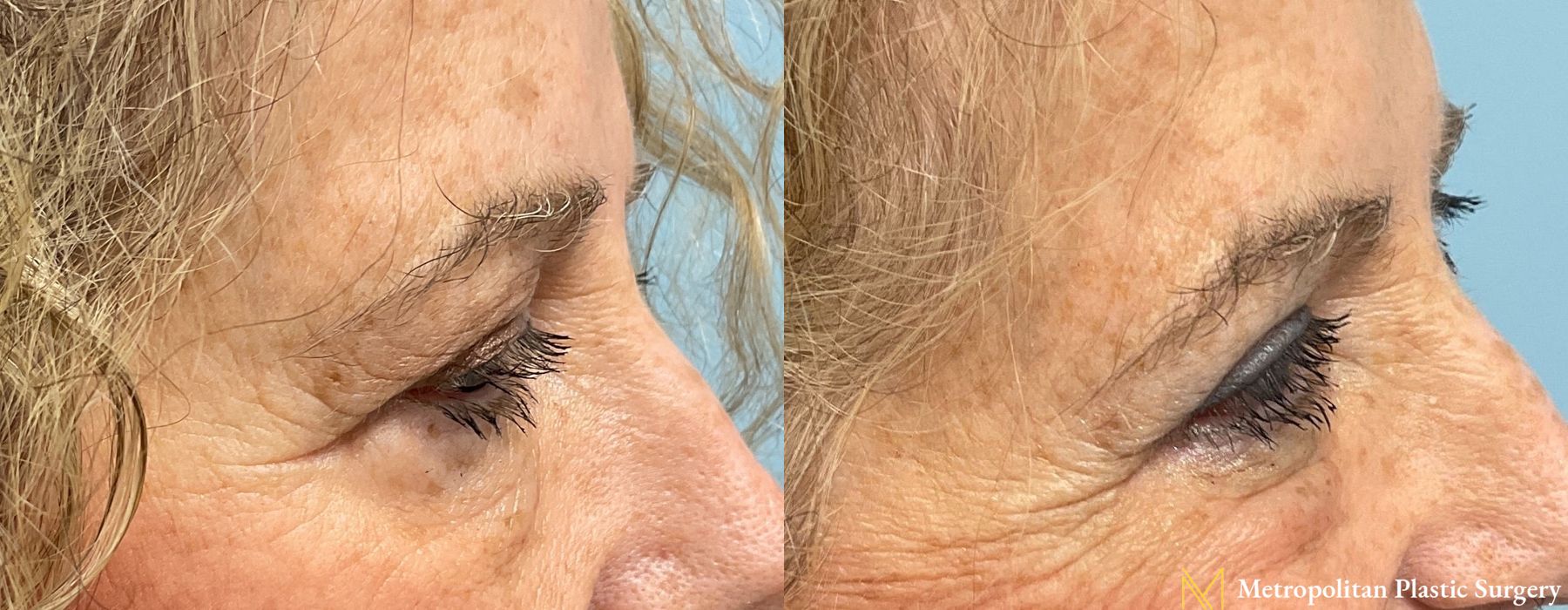 Blepharoplasty - Case 117