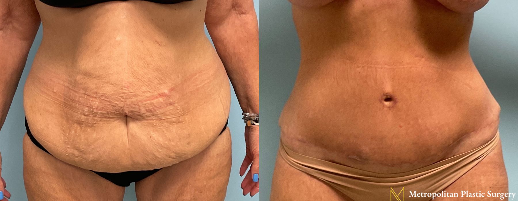 Abdominoplasty - Case 67
