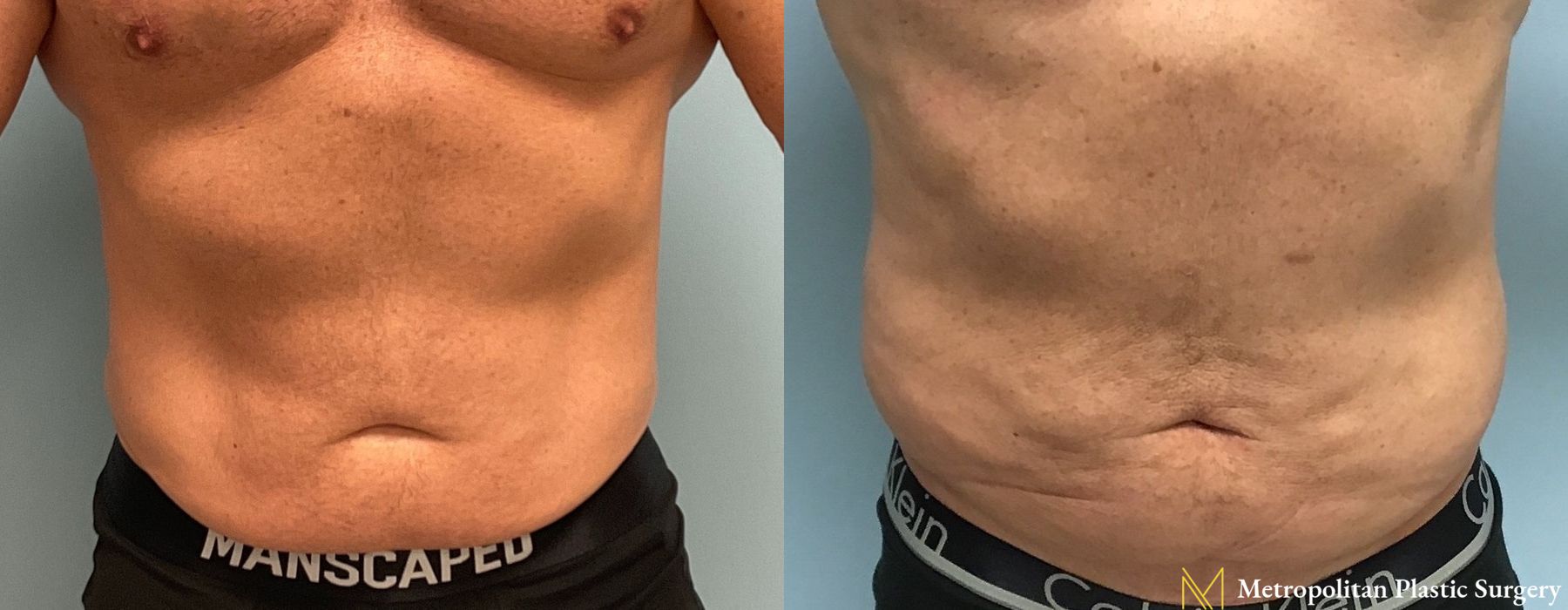 Liposuction - Case 209