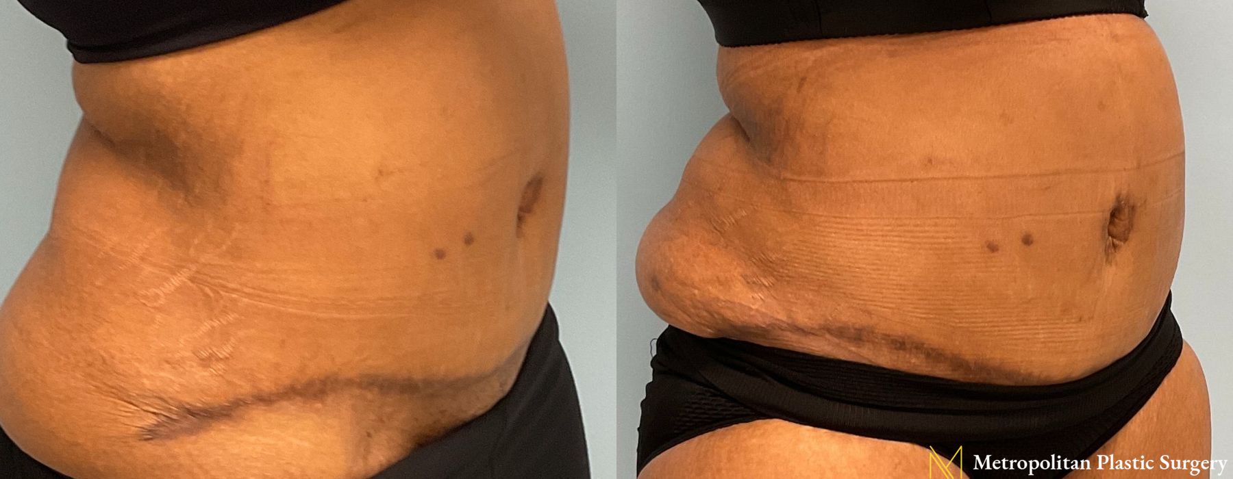 Liposuction - Thumbnail 3