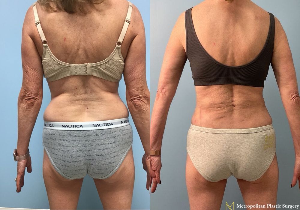 Liposuction - Thumbnail 2