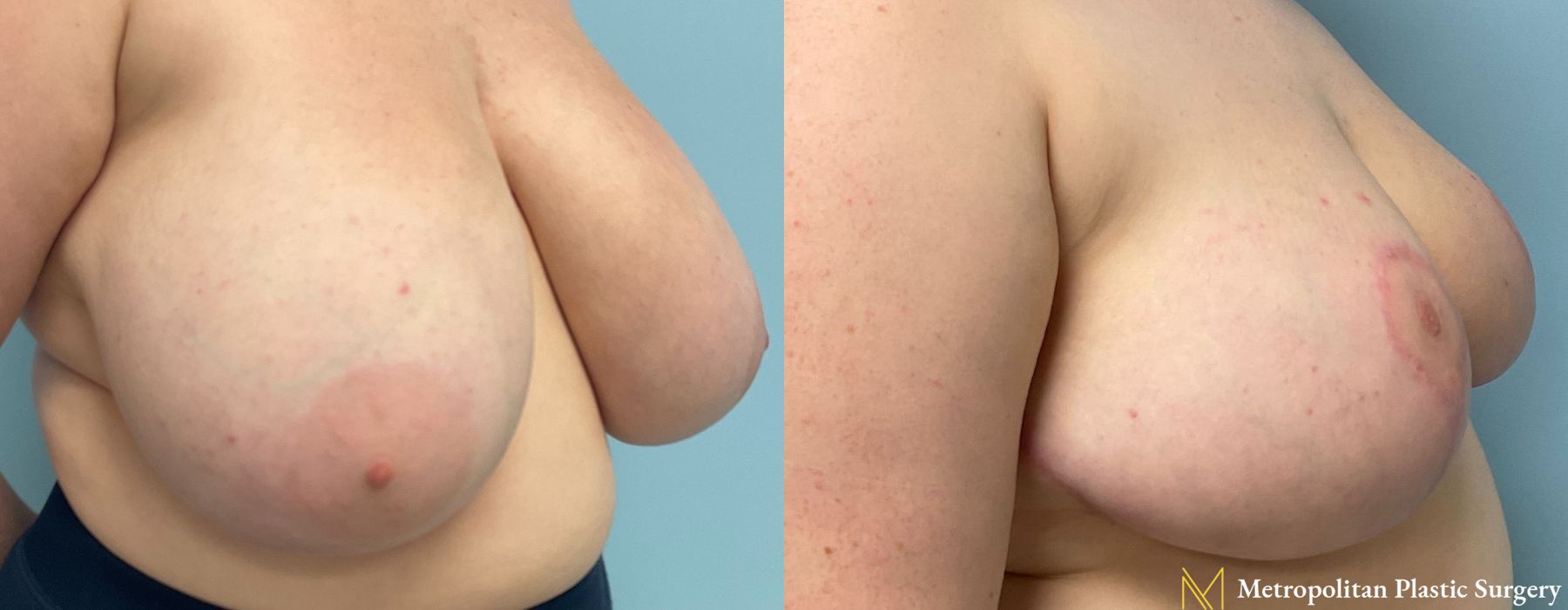 Breast Reduction - Thumbnail 5