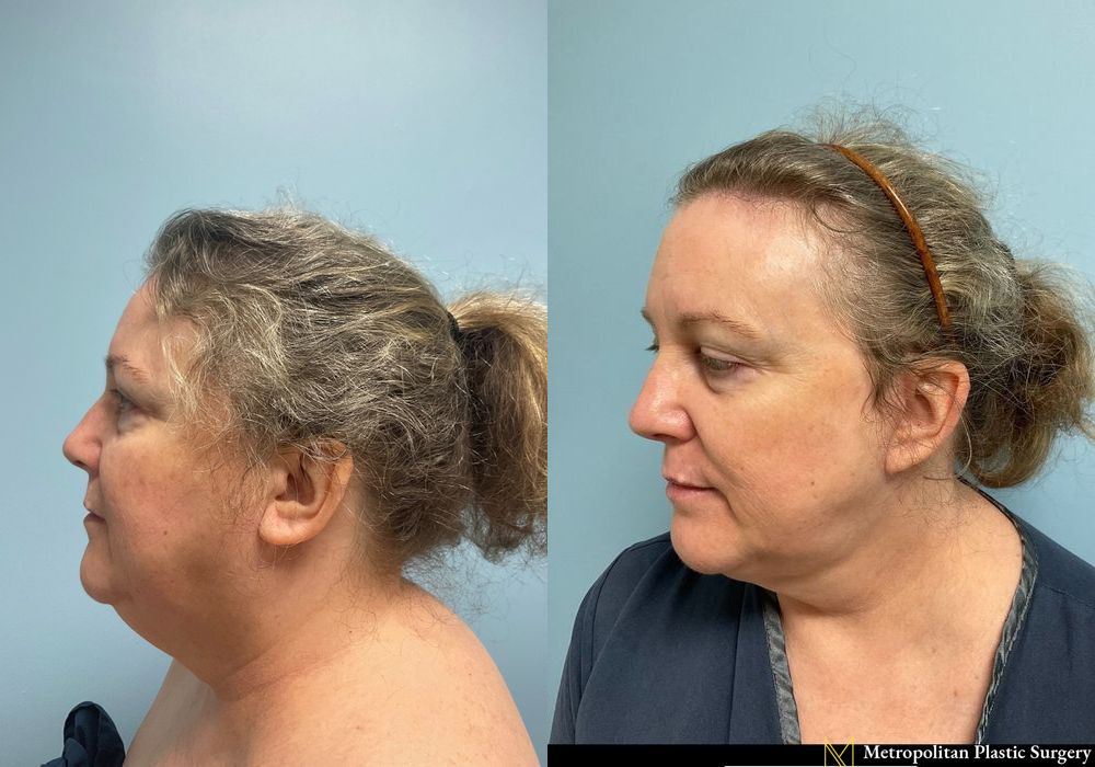 Facelift & Neck Lift - Thumbnail 4