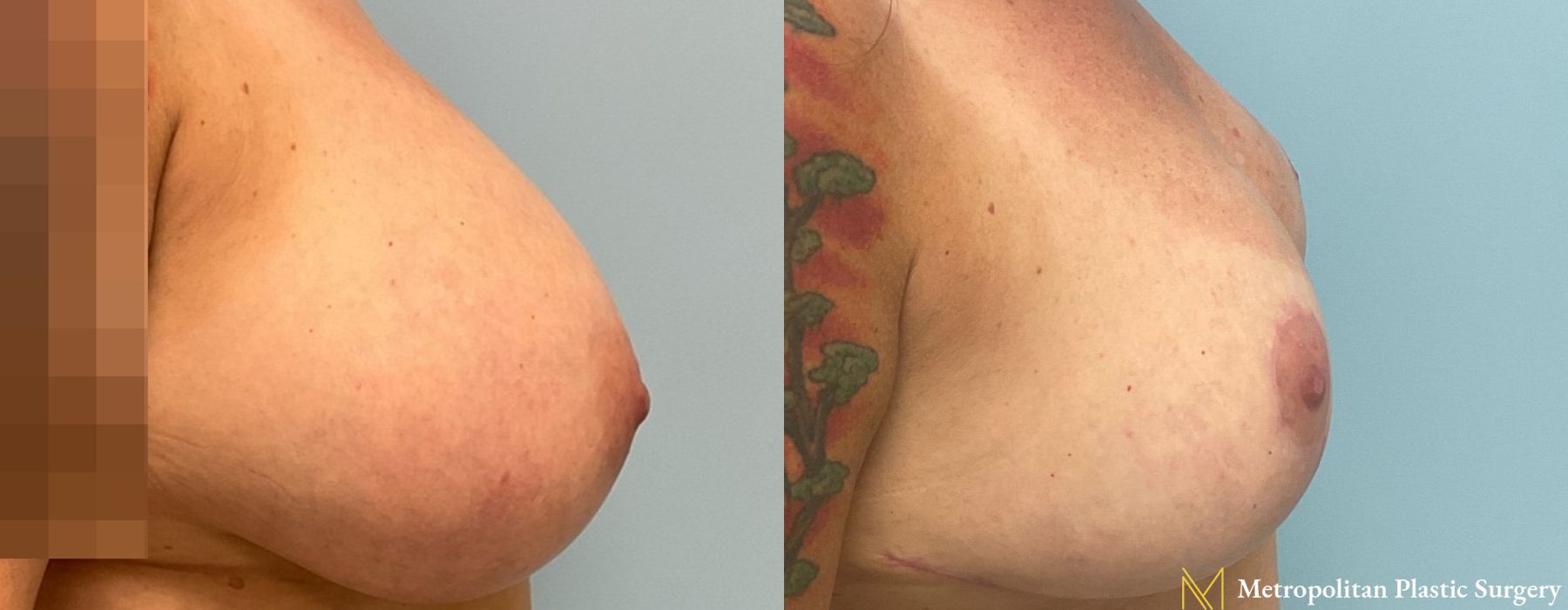 Breast Reduction - Thumbnail 5