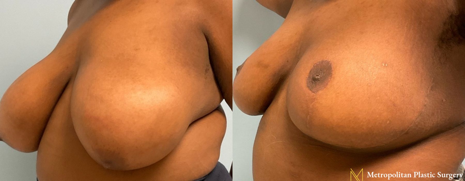 Breast Reduction - Thumbnail 2