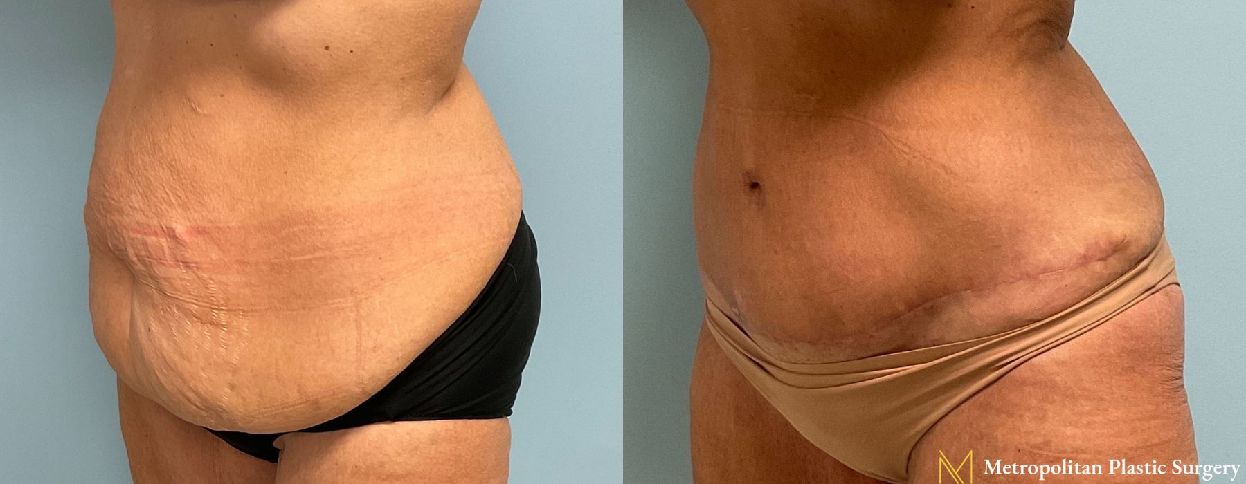 Abdominoplasty - Thumbnail 3