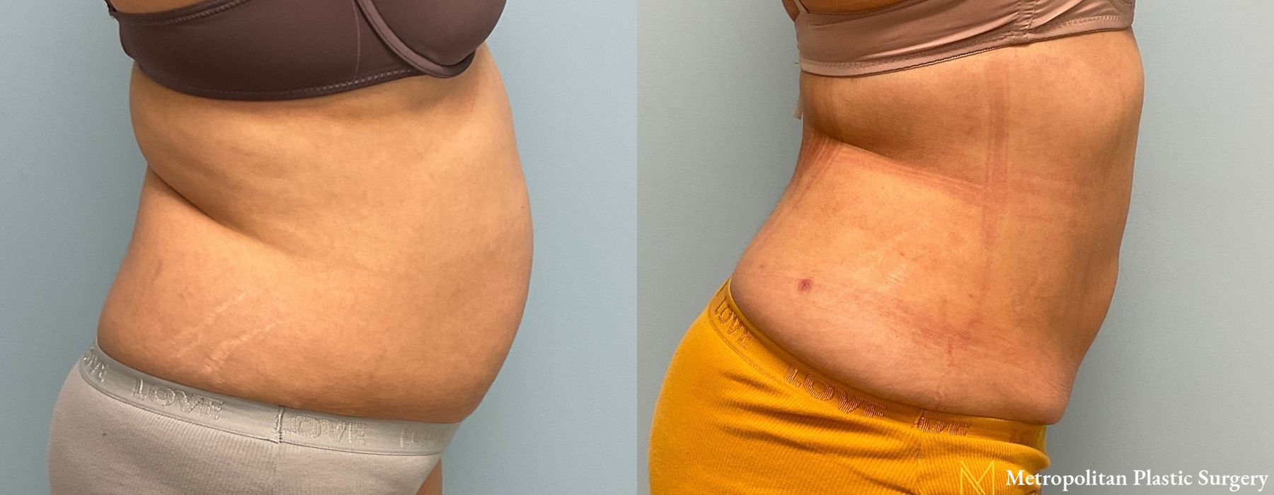 Abdominoplasty - Thumbnail 2