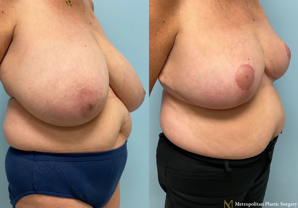 Breast Reduction - Thumbnail 3