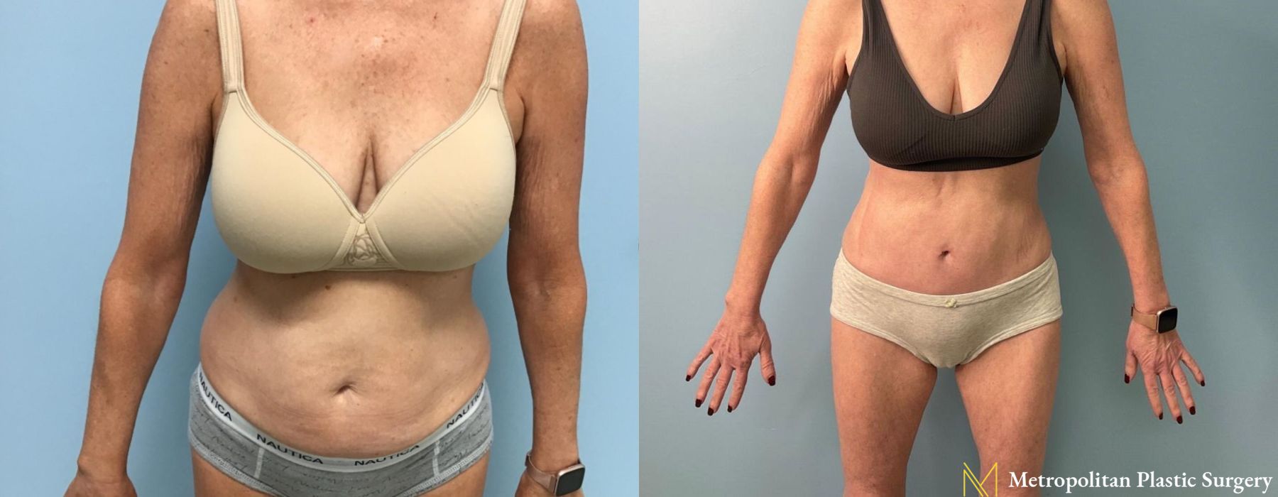 Liposuction - Case 205