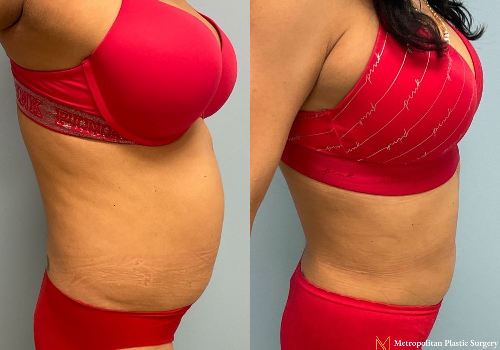 Liposuction - Case 90