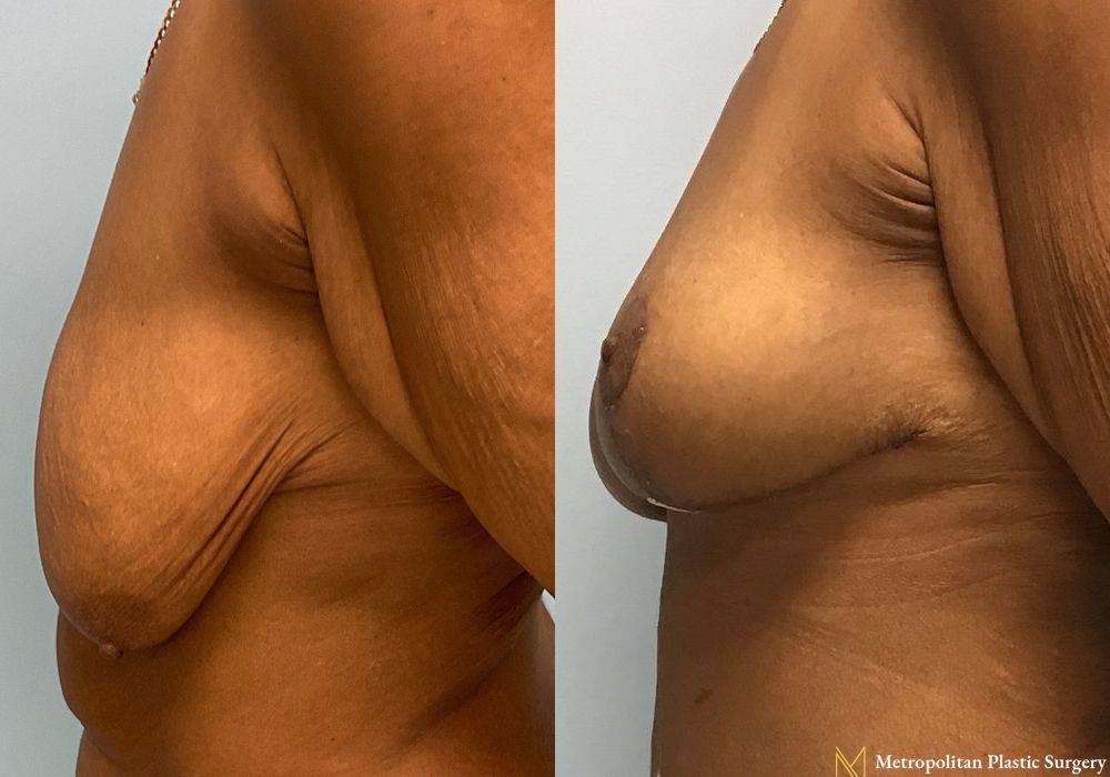 Breast Lift - Thumbnail 2