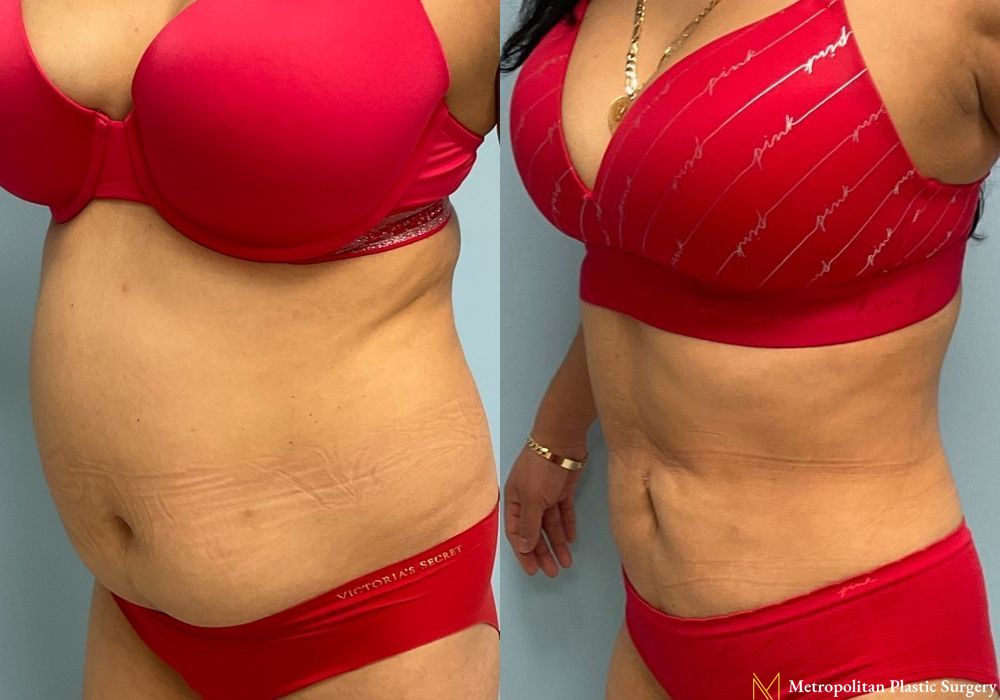 Liposuction - Thumbnail 4