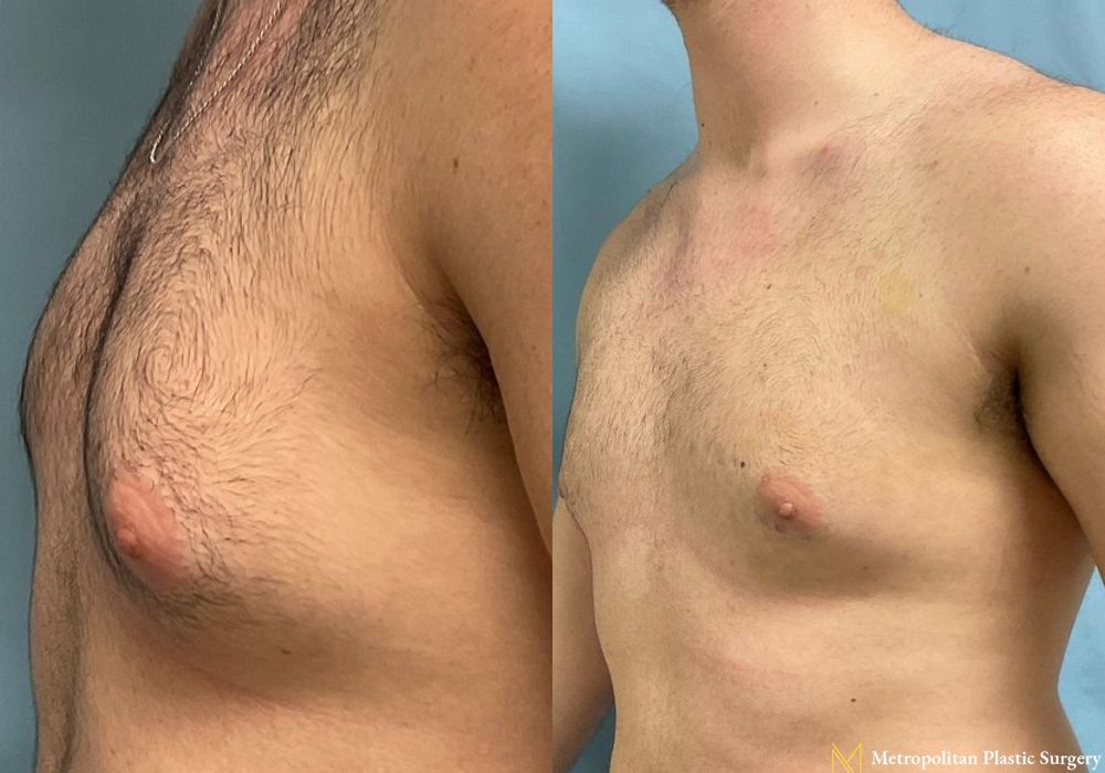 Gynecomastia - Thumbnail 3
