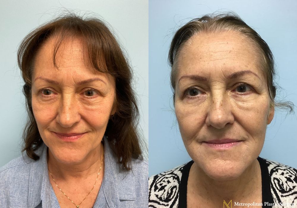 Facelift & Neck Lift - Thumbnail 5