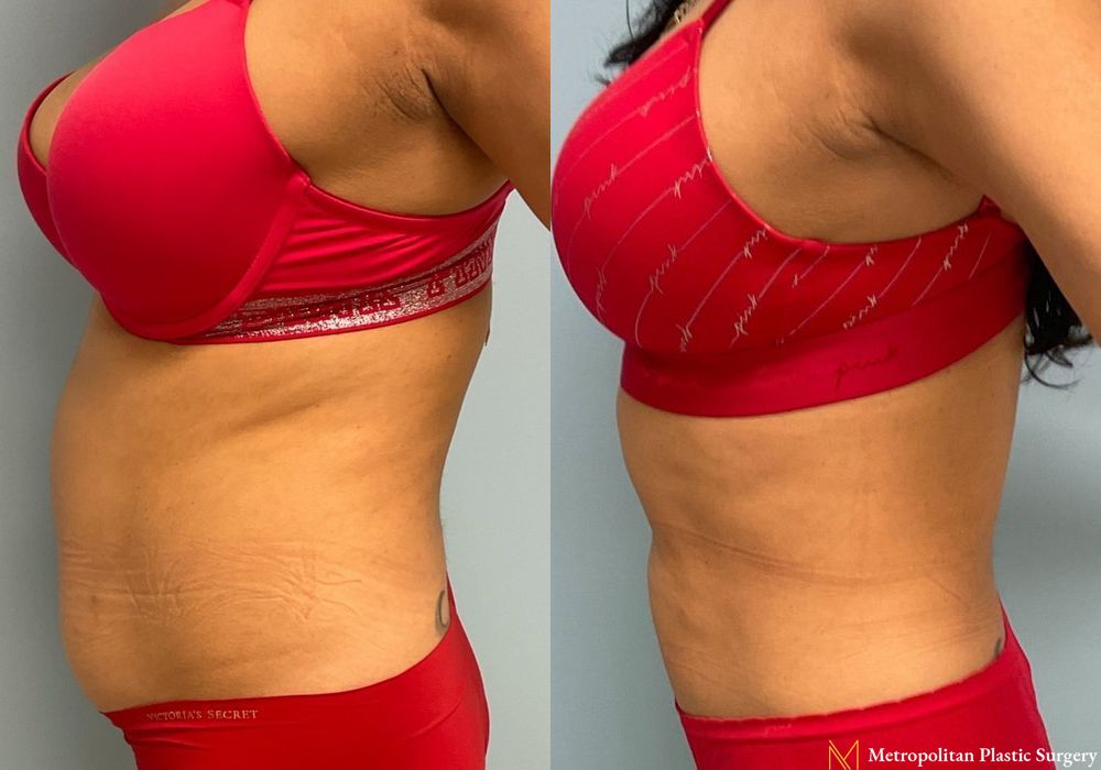 Liposuction - Thumbnail 2