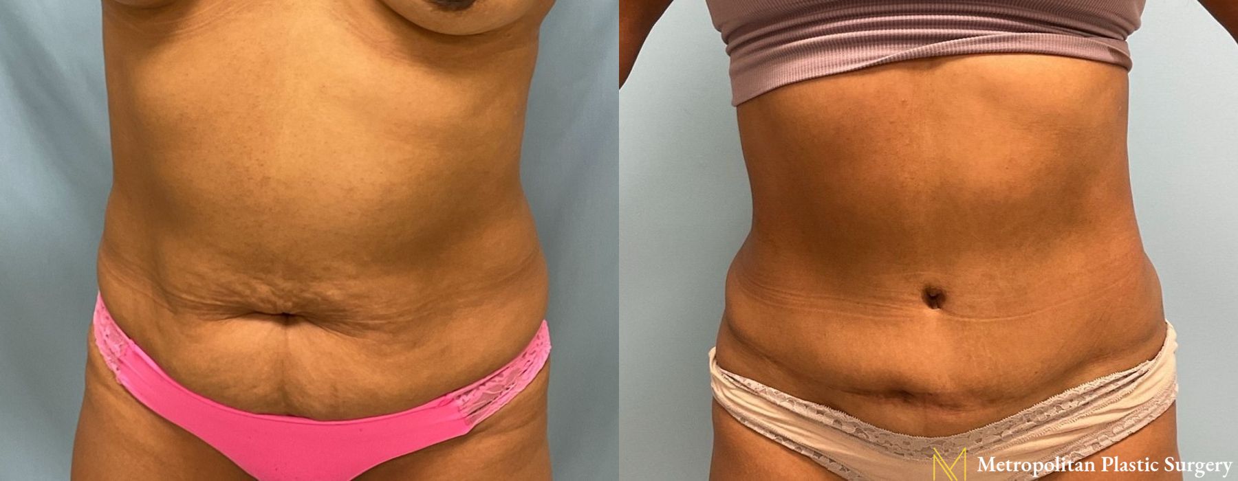 Abdominoplasty - Case 162