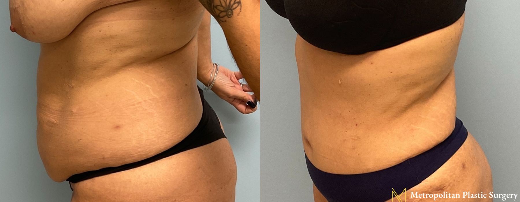 Liposuction - Thumbnail 3