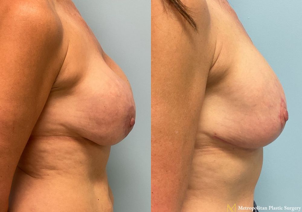 Breast Lift - Thumbnail 2