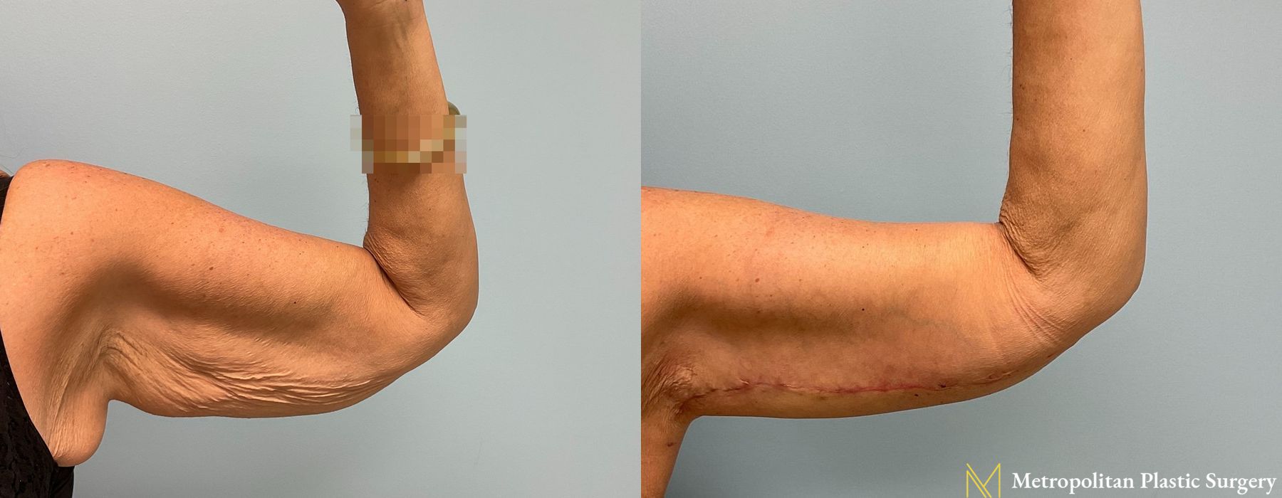 Brachioplasty - Thumbnail 2