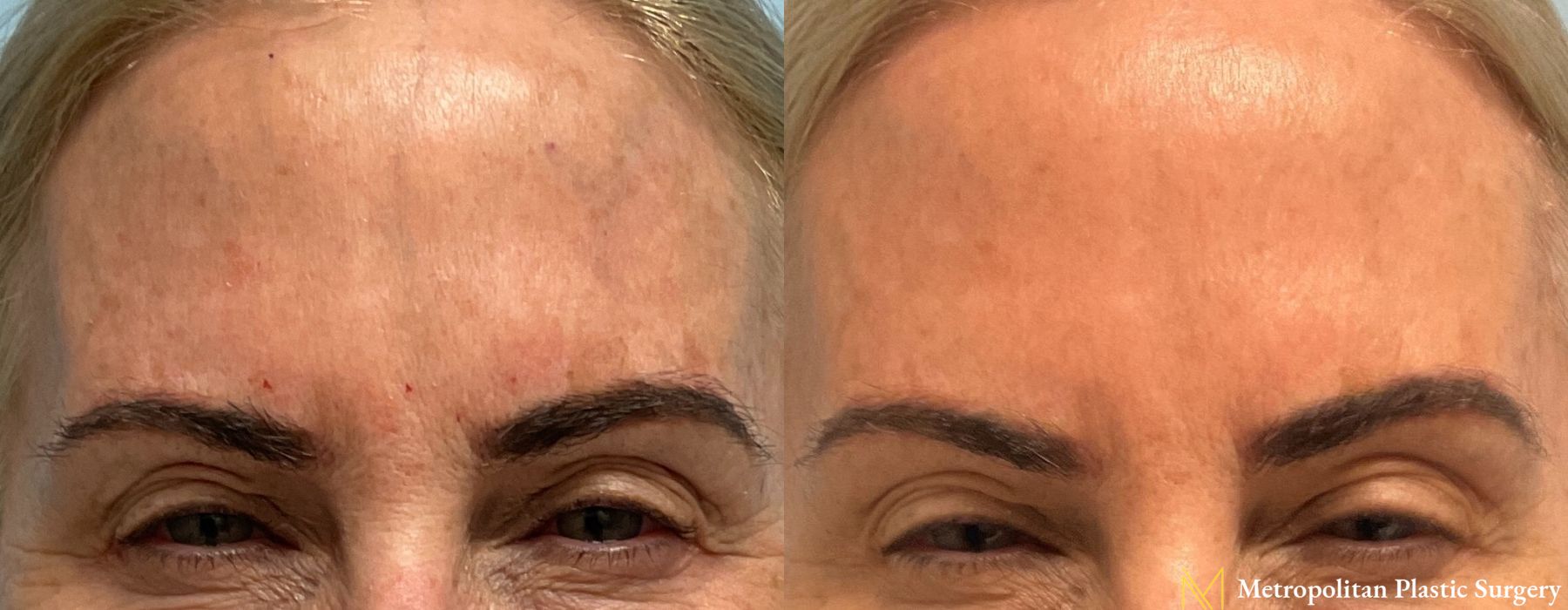 BOTOX® Cosmetic - Case 144