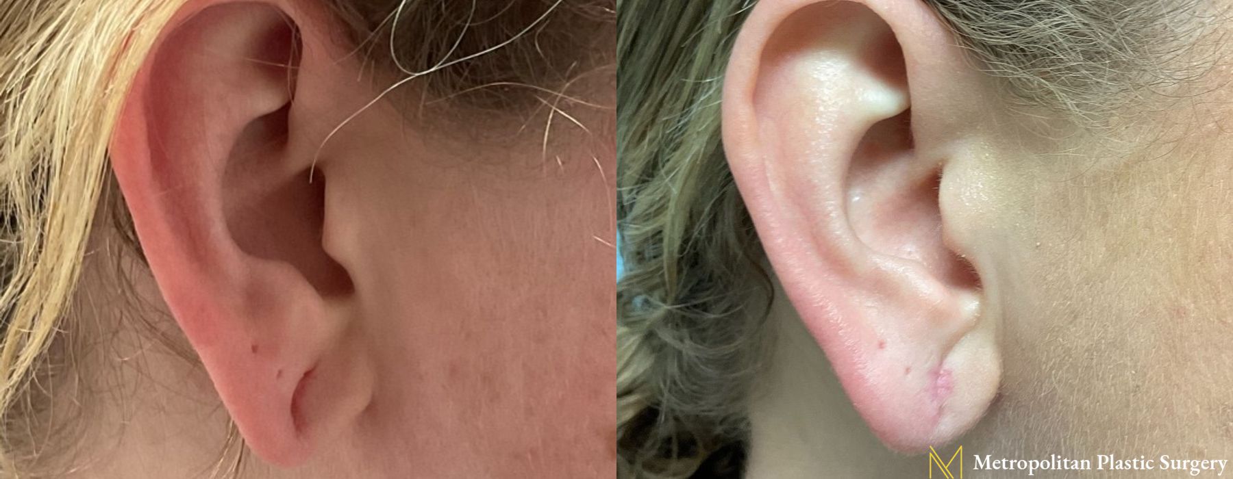 Earlobe Surgery - Thumbnail 2