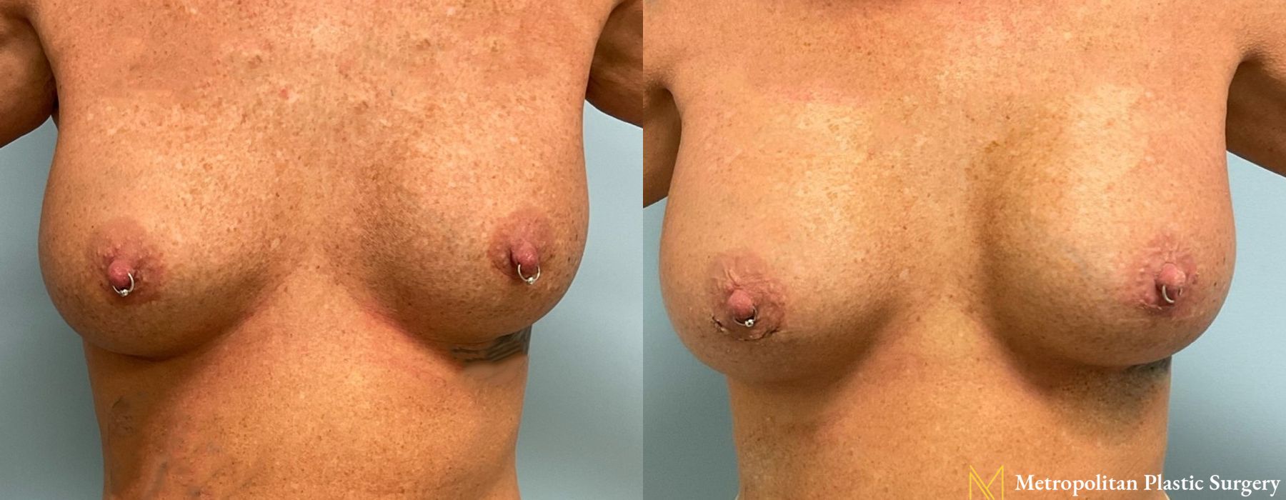 Breast Augmentation - Thumbnail 4