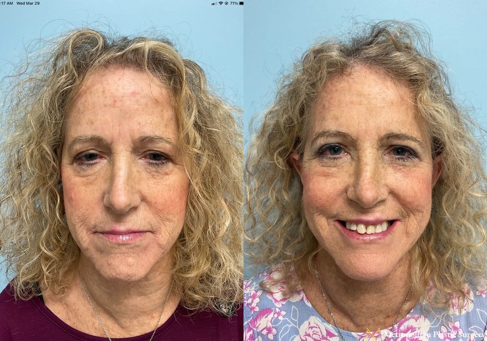 Facelift & Neck Lift - Thumbnail 4