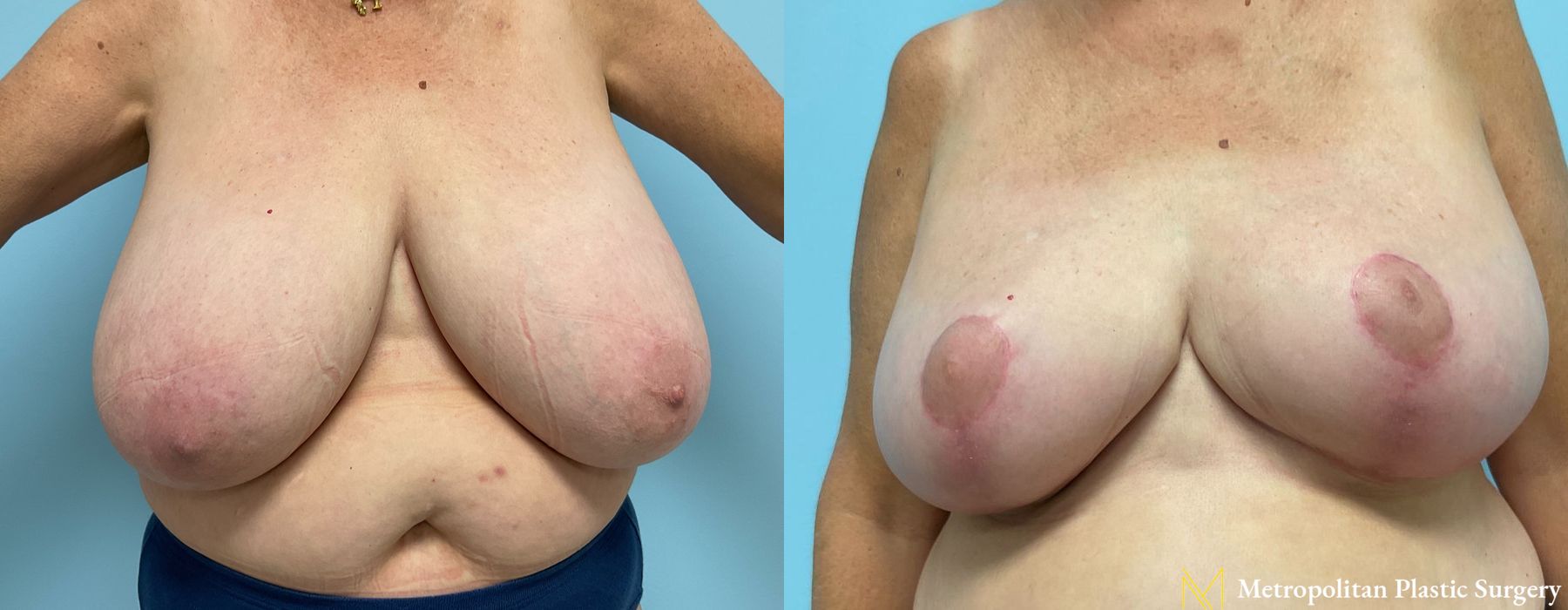 Breast Reduction - Case 265