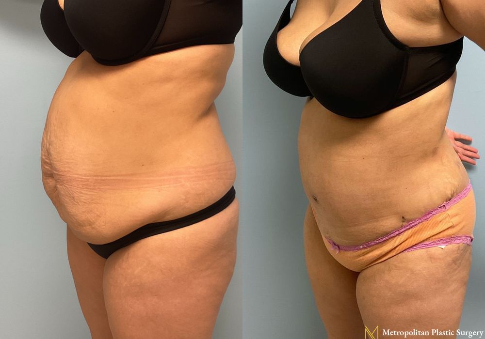 Abdominoplasty - Thumbnail 2