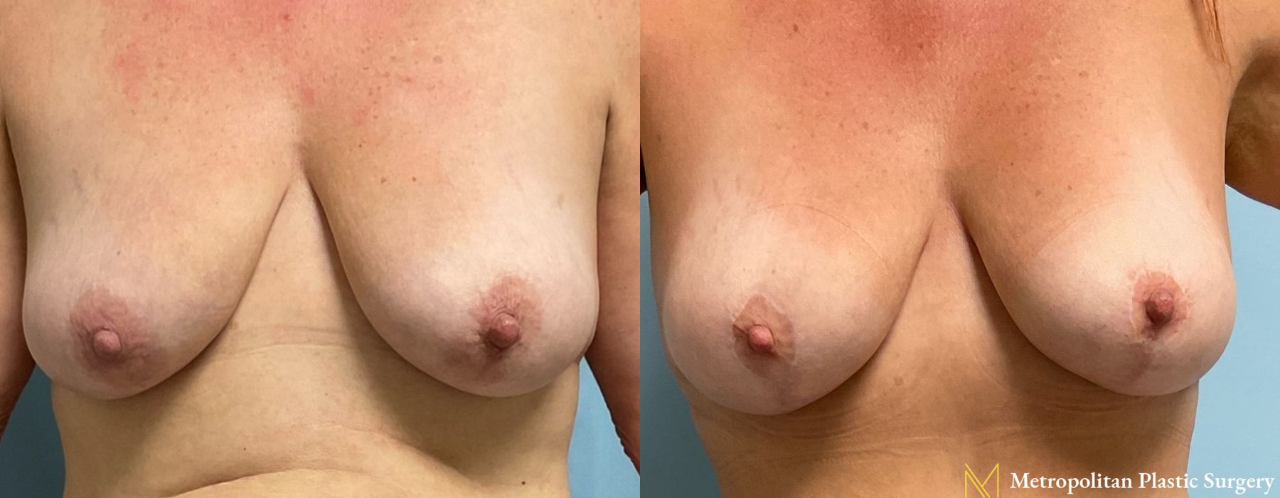 Breast Lift - Case 246
