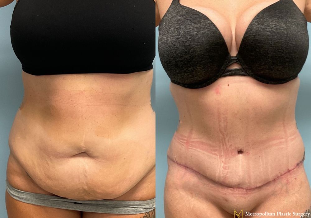 Abdominoplasty - Thumbnail 2