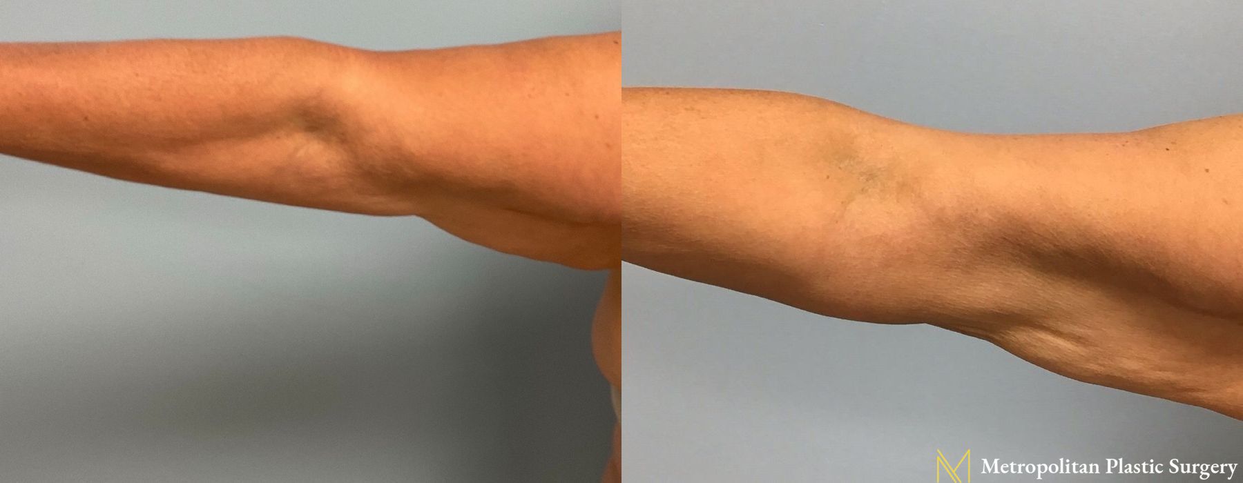 Brachioplasty - Thumbnail 2