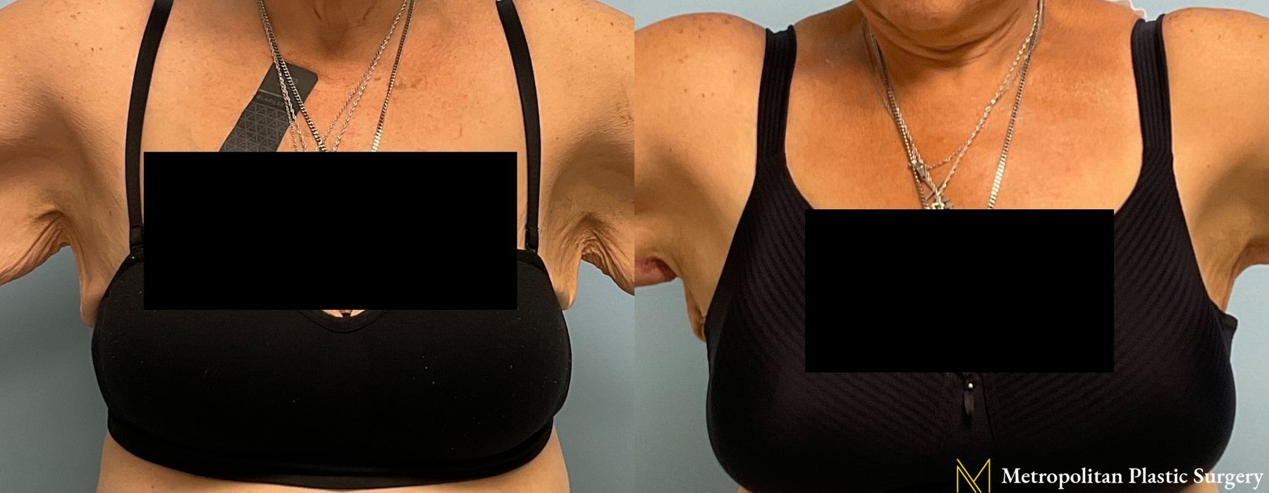 Brachioplasty - Thumbnail 3