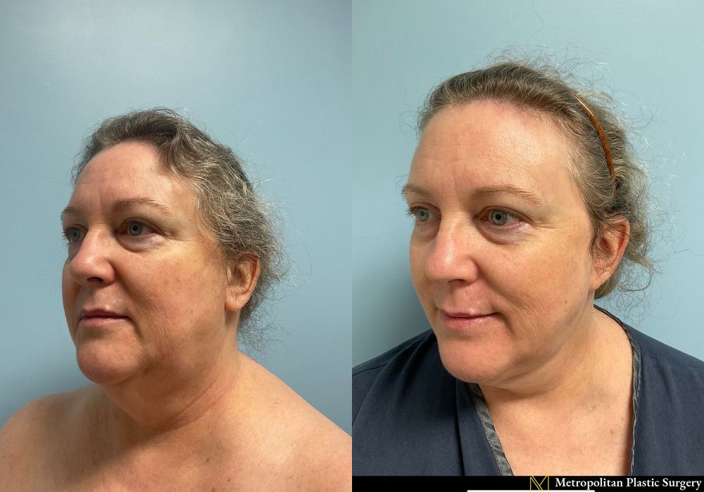 Facelift & Neck Lift - Thumbnail 5