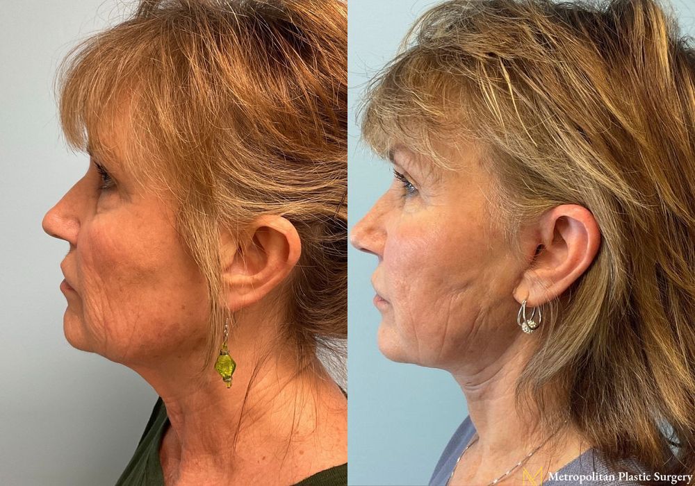 Facelift & Neck Lift - Thumbnail 3